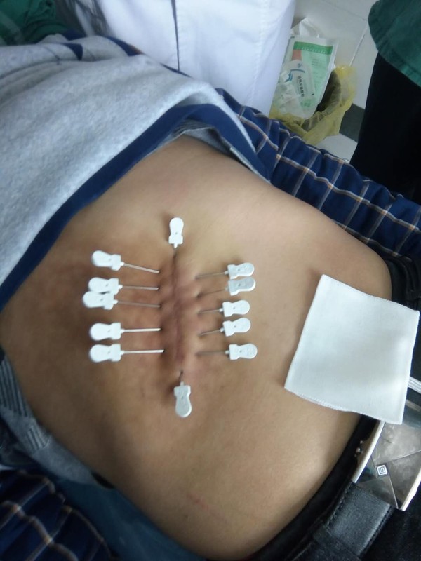 小针刀7.jpg